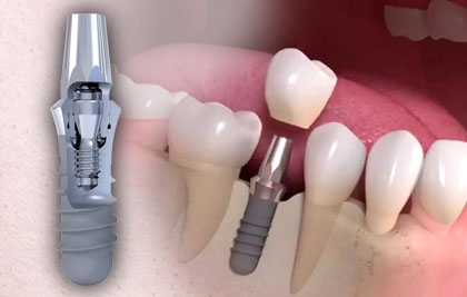 IMPLANTS DENTALS Straumann®
