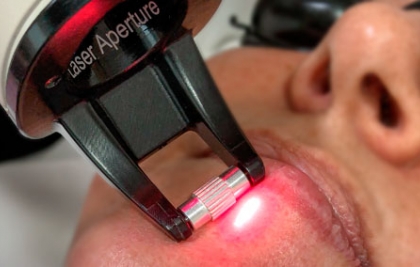​RESURFACING AMB FRAX PRO 1550