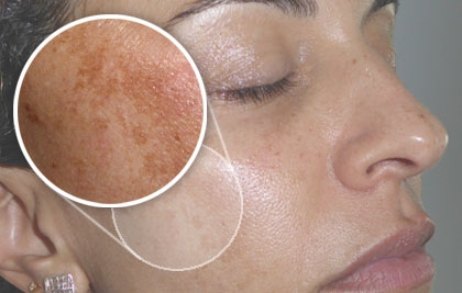 LES 5 CLAUS PER COMBATRE EL MELASMA
