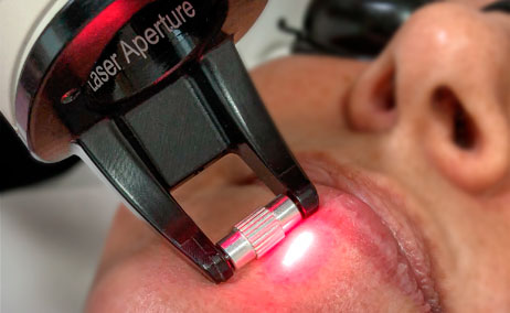  ​RESURFACING AMB FRAX PRO 1550